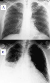 Bệnh viêm phổi nhìn qua phim chụp X-quang: a- Phổi khoẻ mạnh ;b- Phổi của người mắc bệnh