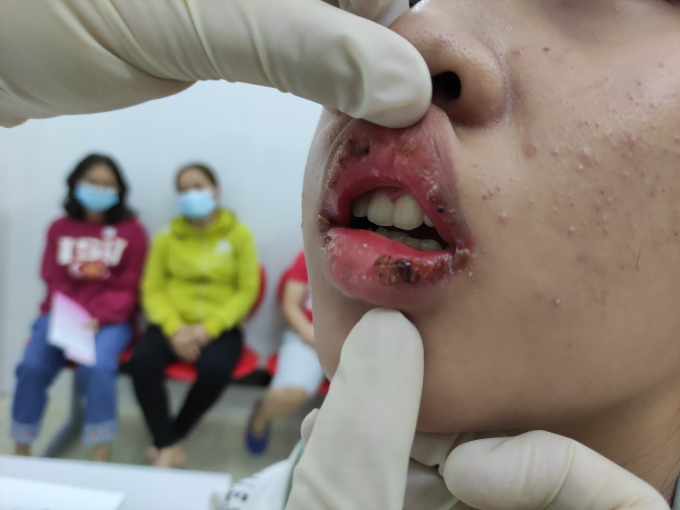 Môi N. bị sưng, rỉ máu, đóng vảy sau khi sử dụng son mua trên mạng. Ảnh: BVCC.