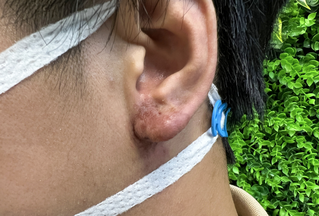 Tai bệnh nhân bị tắc mạch, hoại tử do tiêm chất làm đầy tạo 'tại Phật'. Ảnh: Bệnh viện cung cấp.