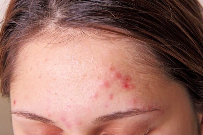 001_forehead_What_The_Acne_On_Every_Part_Of_Your_Body_Is_Trying_To_Tell_You_385615120_TRIG_760x506