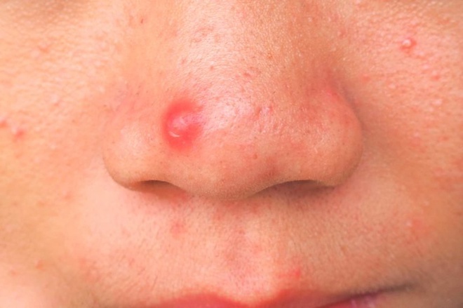 03_t_zone_What_The_Acne_On_Every_Part_Of_Your_Body_Is_Trying_To_Tell_You_649771846_Teenoi_889_760x506
