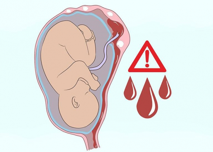 U xơ tử cung dễ gây sảy thai, sinh non (Ảnh minh họa)