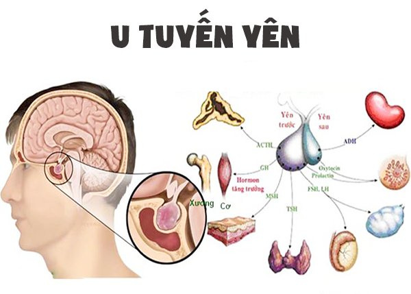 benh-u-tuyen-yen