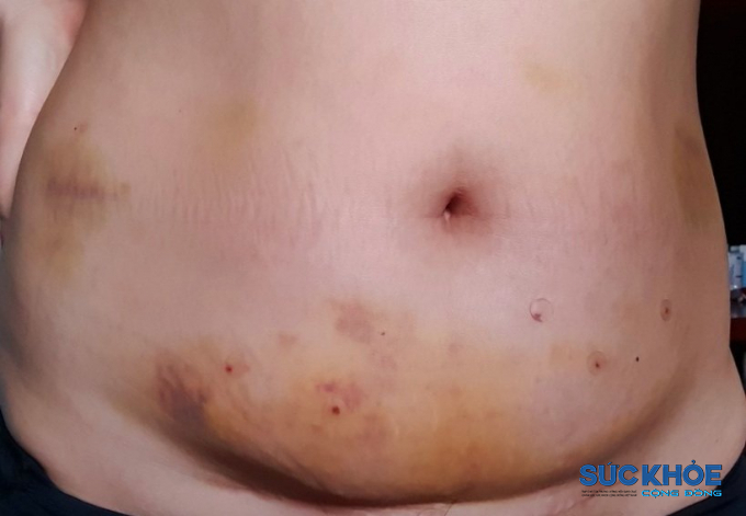 Hình ảnh vùng bụng của chị Hương sau 4 ngày thực hiện cấy chỉ giảm béo công nghệ MaxFire Lipo 4D tại phòng khám chuyên khoa da liễu JK Việt Nam bị xưng, thâm và rất đau (ảnh do chị Hương cung cấp)