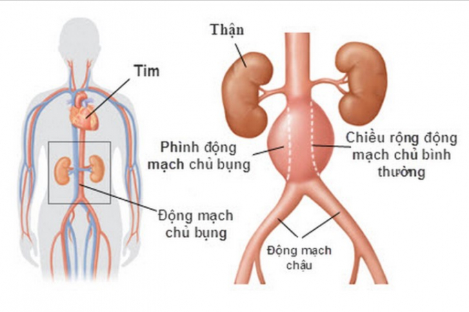 phinh_dong_mach