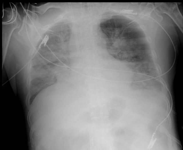 Hình ảnh X-quang phổi của bệnh nhân. Ảnh: BVCC