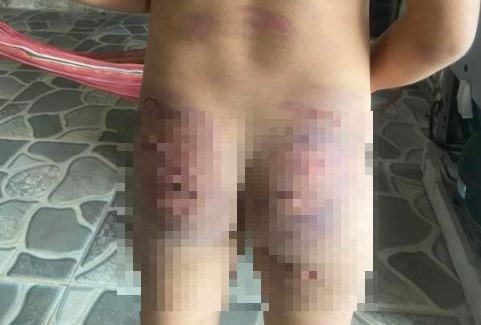 Hình ảnh bé gái nghi bị bạo hành với chi chít vết thương phía sau người lan truyền trên mạng. Ảnh: LĐO