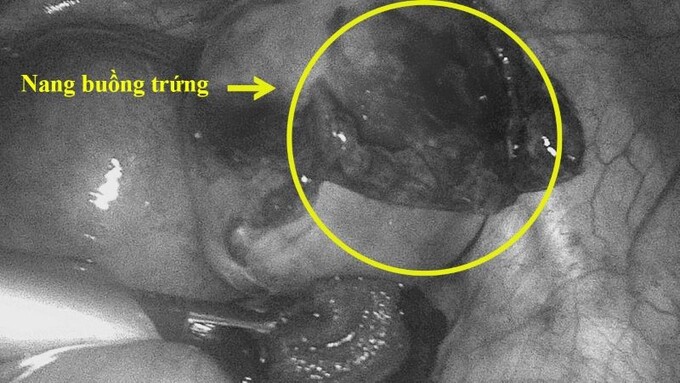 Hình ảnh nang buồng trứng của bệnh nhân