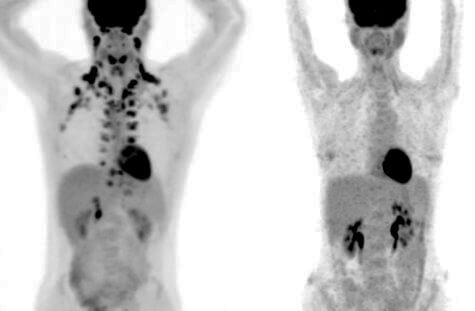 Ảnh PET của người có nhiều mỡ nâu ở cổ và xương sống (trái), trong khi người còn lại không có mỡ nâu. Ảnh: Study Finds