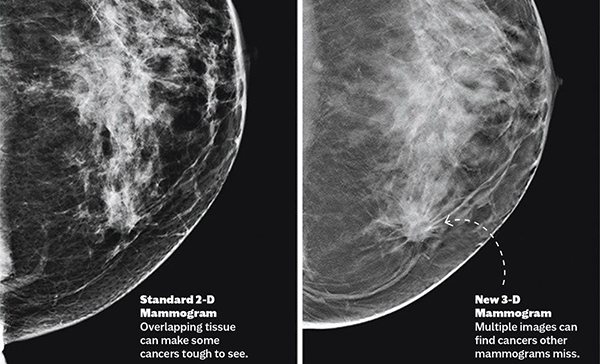 So với chụp nhũ ảnh 2D (trái), chụp nhũ ảnh 3D (phải) giúp bác sĩ phát hiện khối u dễ dàng và chính xác hơn. Ảnh: Prevention