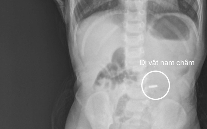 Hình ảnh dị vật nam châm qua phim chụp X-quang. Ảnh: BVCC