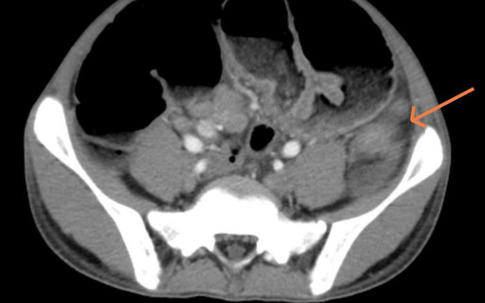 Hình ảnh cắt lớp vi tính ổ bụng. Ảnh: BVCC