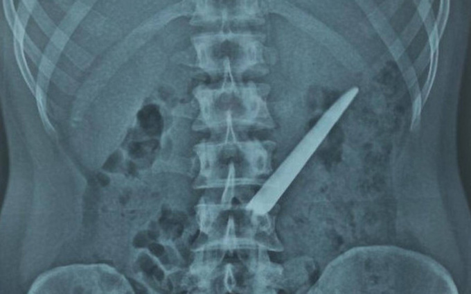 Hình ảnh lưỡi dao nằm trong bụng bệnh nhân. Ảnh: BGT