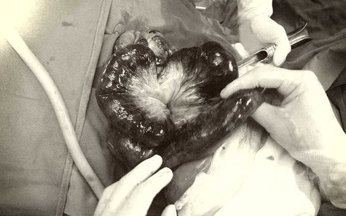 Toàn bộ đoạn ruột hoại tử tím đen của bệnh nhân được các bác sĩ phẫu thuật cắt bỏ. Ảnh: BVCC