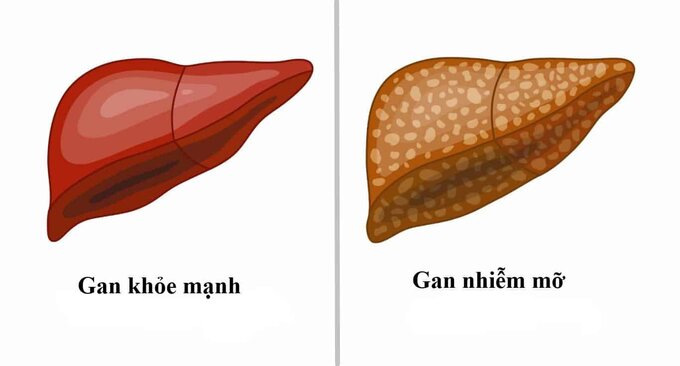 Điều trị gan nhiễm mỡ bằng các thảo dược thiên nhiên. Ảnh minh họa