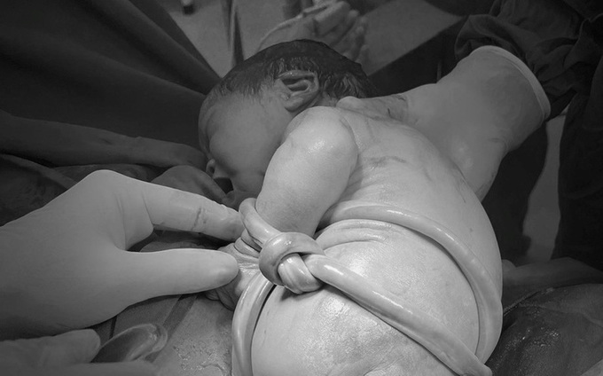 Bé sơ sinh chào đời với dây rốn thắt nút, cuốn thân. Ảnh: Sở Y tế Phú Thọ