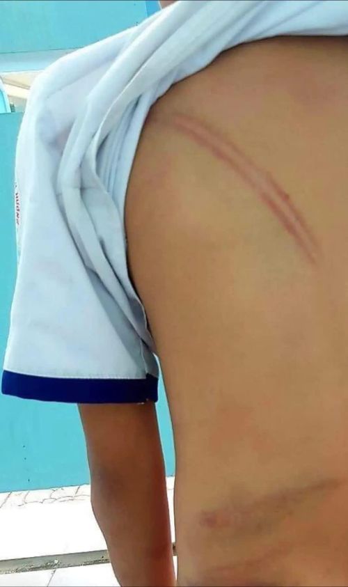 Vết bầm tím nằm trên cơ thể bé T. Ảnh: Camau.gov (Báo Tiền phong)