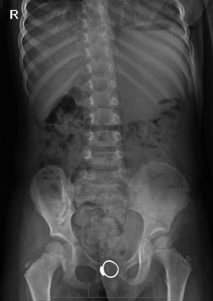 Hình ảnh chụp X-quang cho thấy dị vật kim loại hình nhẫn trong âm đạo. Ảnh: Sức khỏe đời sống