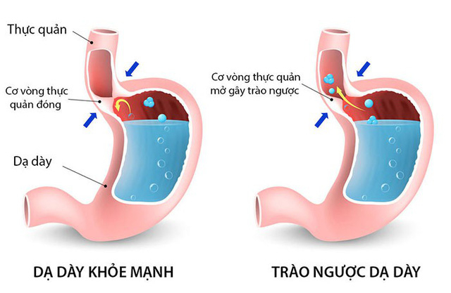 Stress và bệnh trào ngược dạ dày thực quản có mối liên hệ gì? Ảnh: Thầy thuốc Việt Nam