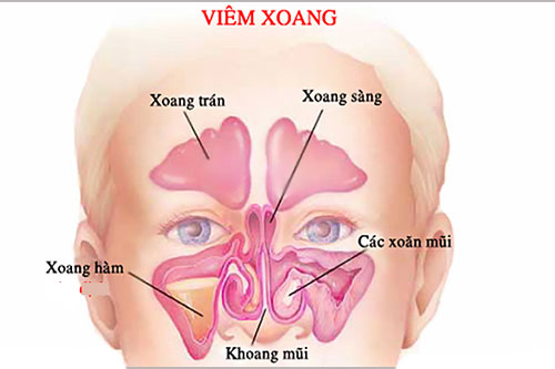 Những điều cần biết về viêm xoang trán. Ảnh: Thầy thuốc Việt Nam