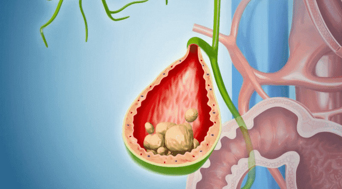 Cách trị sỏi mật tại nhà đơn giản, giảm đau nhanh, bài sỏi. Ảnh: Thầy thuốc Việt Nam