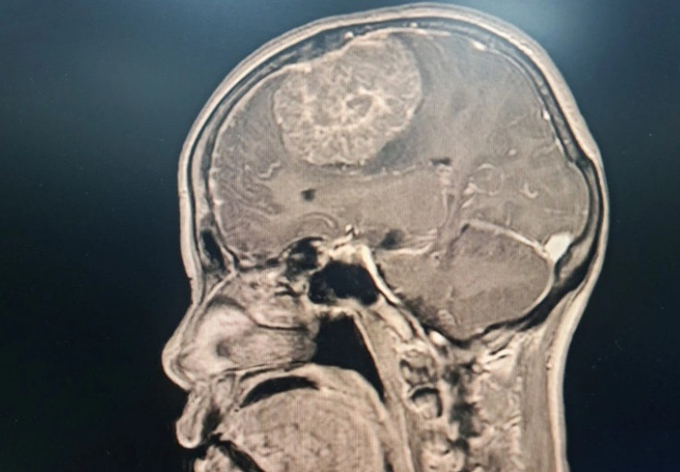 Hình ảnh khối u của bệnh nhân trên phim chụp MRI sọ não tiêm chất tương phản. Ảnh: BVCC (VTV)