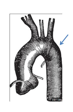 Vị trí xương cá đâm vào động mạch chủ ngực xuống