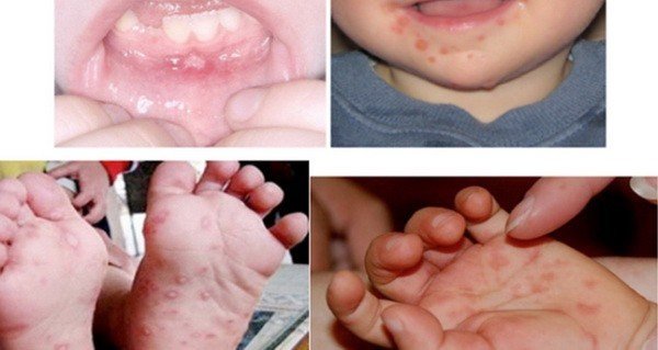Một số dấu hiệu nhận biết bệnh tay chân miệng như loét miệng, lợi, lưỡi, phỏng nước ở lòng bàn tay, bàn chân...
