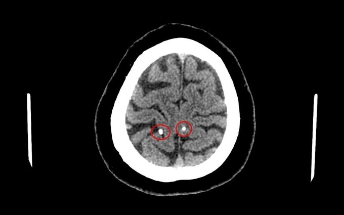 Hình ảnh nang ký sinh trùng trong não người bệnh. Ảnh: Sở y tế Phú Thọ