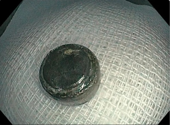 Hình ảnh pin cúc áo khi được lấy ra khỏi bệnh nhi. Ảnh: Thanhphohaiphong.gov