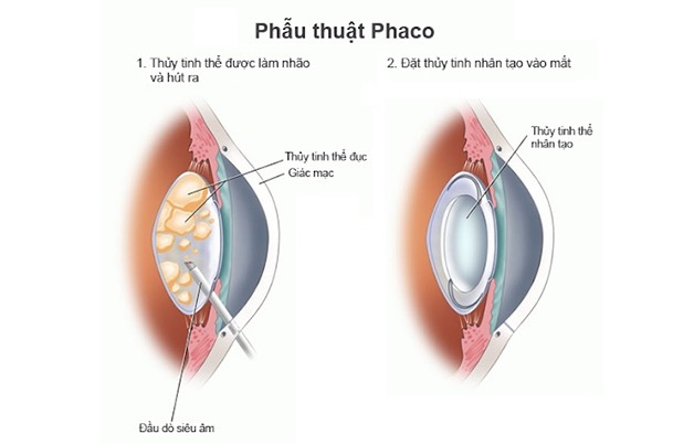 Phẫu thuật Phaco