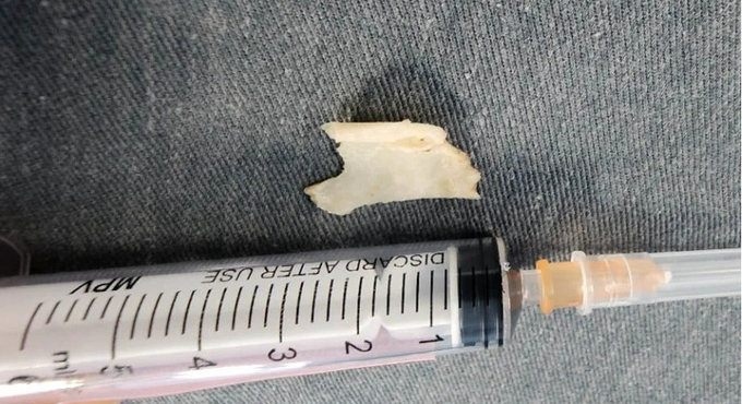 Mảnh xương được gắp ra từ thực quản bệnh nhân. Ảnh: Thongtinhaiphong.gov