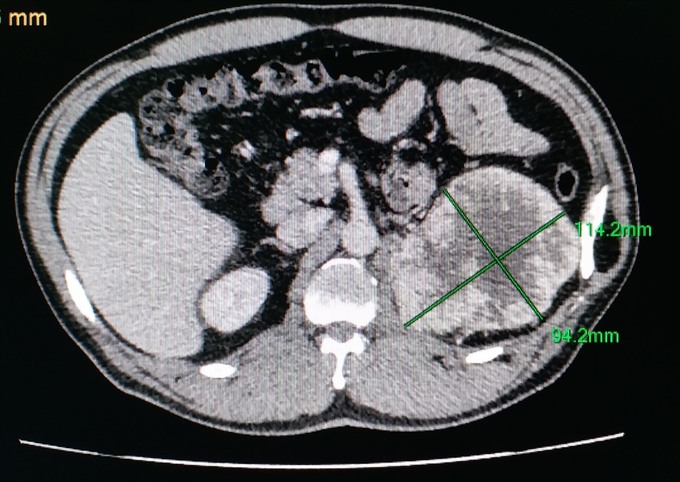 Hình ảnh chụp CTscan cho thấy khối u thận kích thước khá lớn. Ảnh: BVCC (Báo Quảng Nam)