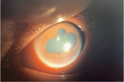 Viêm nội nhãn là tình trạng viêm nghiêm trọng các mô trong mắt, dễ dẫn đến mù loà. Ảnh: Bệnh viện Mắt Hà Nội 2