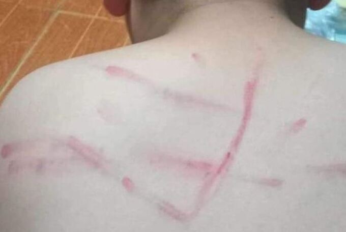 Những vết bầm tím trên lưng của nam sinh sau khi bị cô giáo dùng roi đánh. Ảnh: Người nhà phản ánh và đăng tải lên mạng xã hội (LĐO)