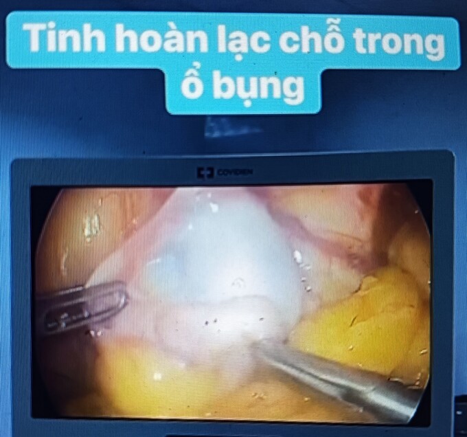 Tinh hoàn lạc trong ổ bụng bệnh nhân. Ảnh: Bệnh viện 115