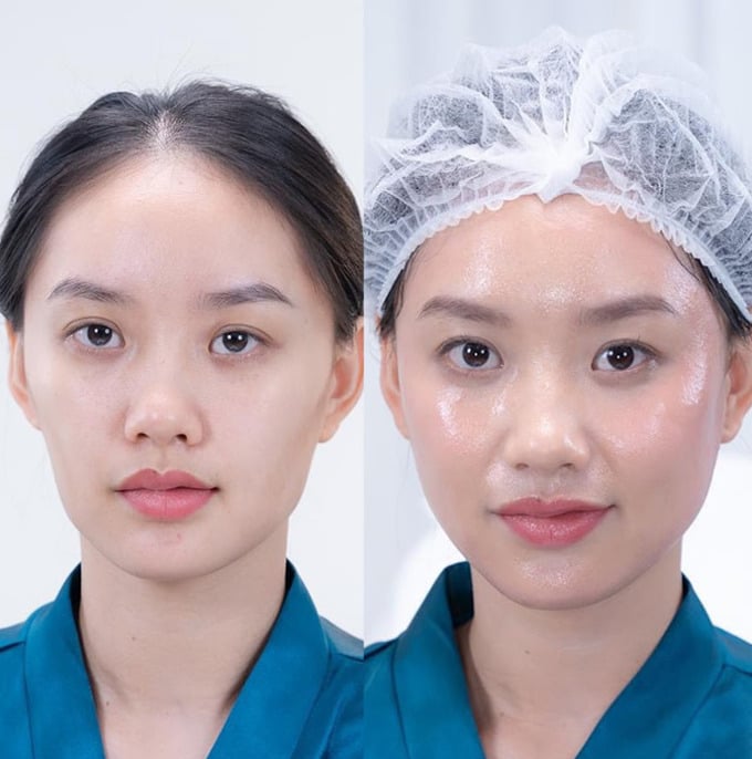 Hình ảnh của khách hàng trước và sau khi thực hiện Maxfill Nano dưới bàn tay của  bác sĩ Huệ Nguyễn