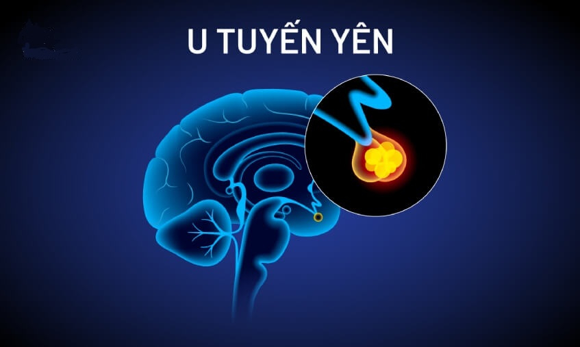 khoi-u-tuyen-yen