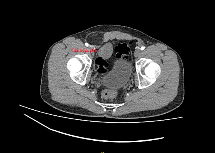 Hình ảnh CT tinh hoàn phải nằm trong bụng (Ảnh: BVCC)