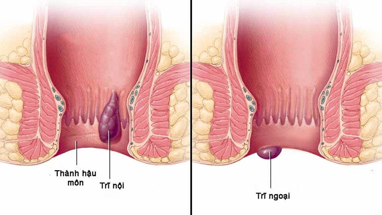 tri