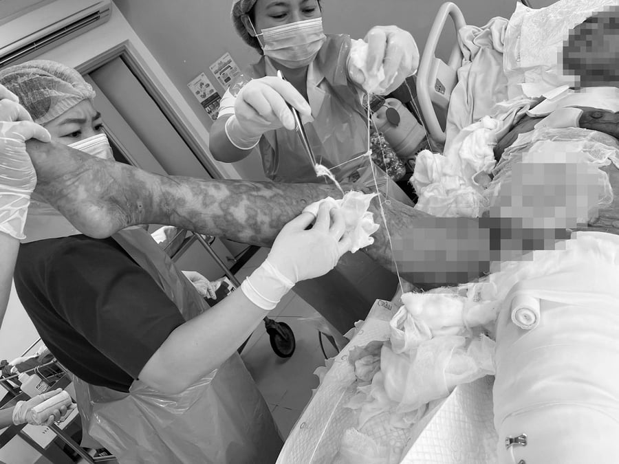 Mỗi lần thay băng kéo dài gần hai giờ, cần 5–6 nhân viên thực hiện phối hợp (Ảnh: BVCC)