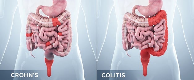 benh-crohn-1