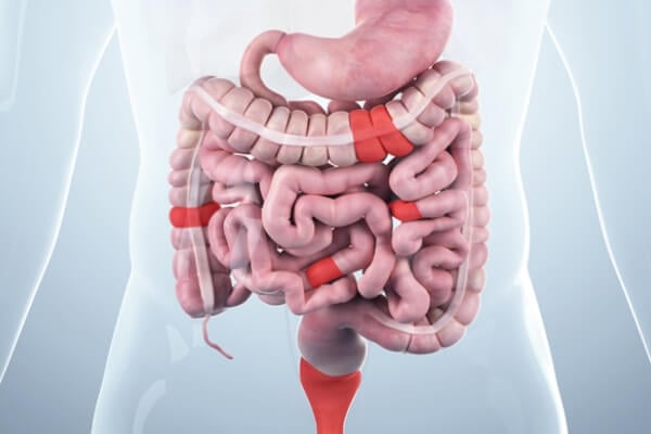 crohn