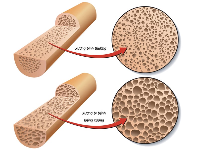 Thiếu vitamin D là một trong những nguyên nhân chính gây ra tình trạng loãng xương.