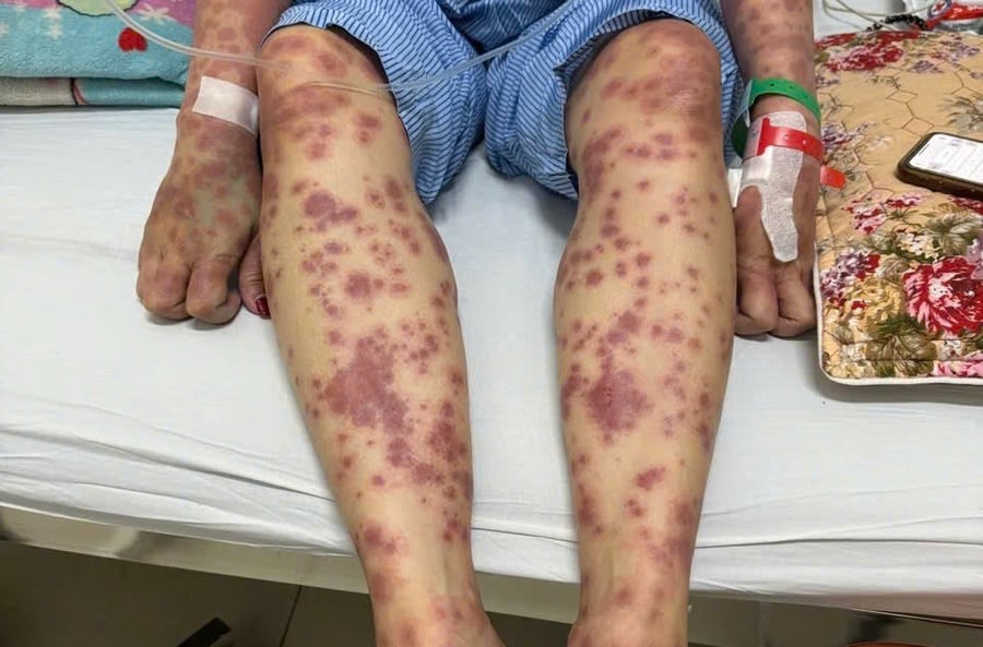 Các nốt ban đỏ xuất hiện khắp người của bệnh nhân A.T. sau một tháng uống thuốc giảm cân không rõ nguồn gốc. Ảnh: BV