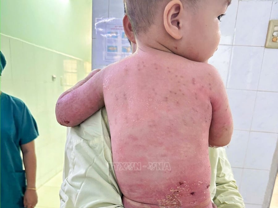 Thời điểm xuất viện, toàn bộ da bị bỏng nặng trước đây của B.P.T. (2 tuổi, ngụ tỉnh Gia Lai) đã phục hồi hoàn toàn.