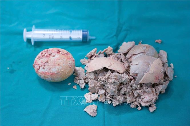 Viên sỏi hơn 10cm được lấy ra thành công từ bàng quang của bệnh nhân V.T.T.N (36 tuổi, trú tại phường Pleiku, tỉnh Gia Lai). Ảnh: TTXVN phát