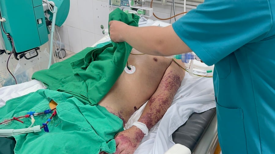 Bệnh viện Bạch Mai đã ghi nhận 3 trường hợp nghi nhiễm liên cầu lợn liên quan tới chùm bệnh phát sinh tại Hưng Yên chỉ trong 2 tuần đầu tháng 7