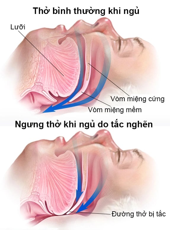 Hình ảnh đường hô hấp trên bình thường, luồng khí thở thông thoáng và đường hô hấp trên khi bị tắc nghẽn. Ảnh: VnExpress