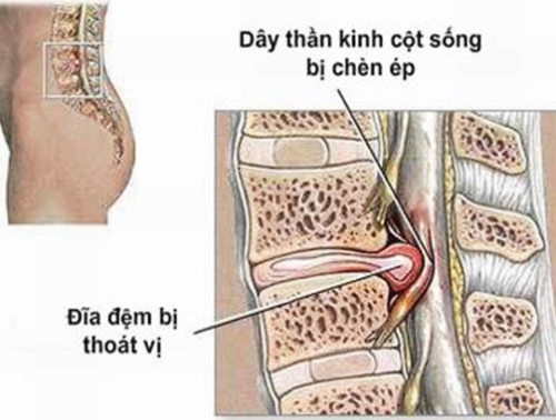 dau lung lan xuong chan la dau hieu benh gi 1